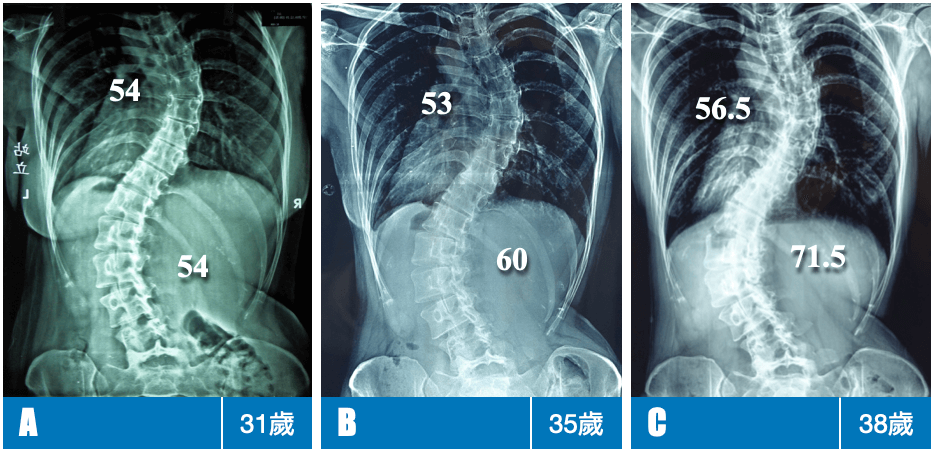 31歲至38歲側彎度數變化