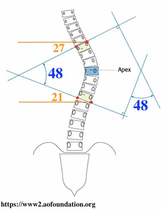 脊椎側彎度數測量方式cobb angle