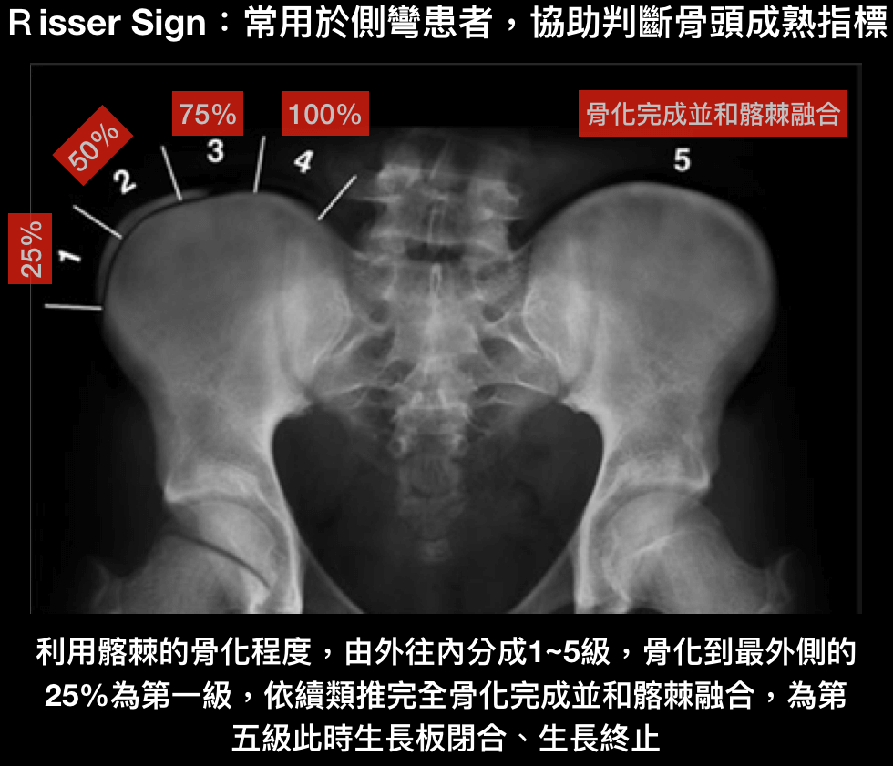 Risser sign,生長板閉合, 脊椎側彎, 骨齡判斷,脊椎側彎評估