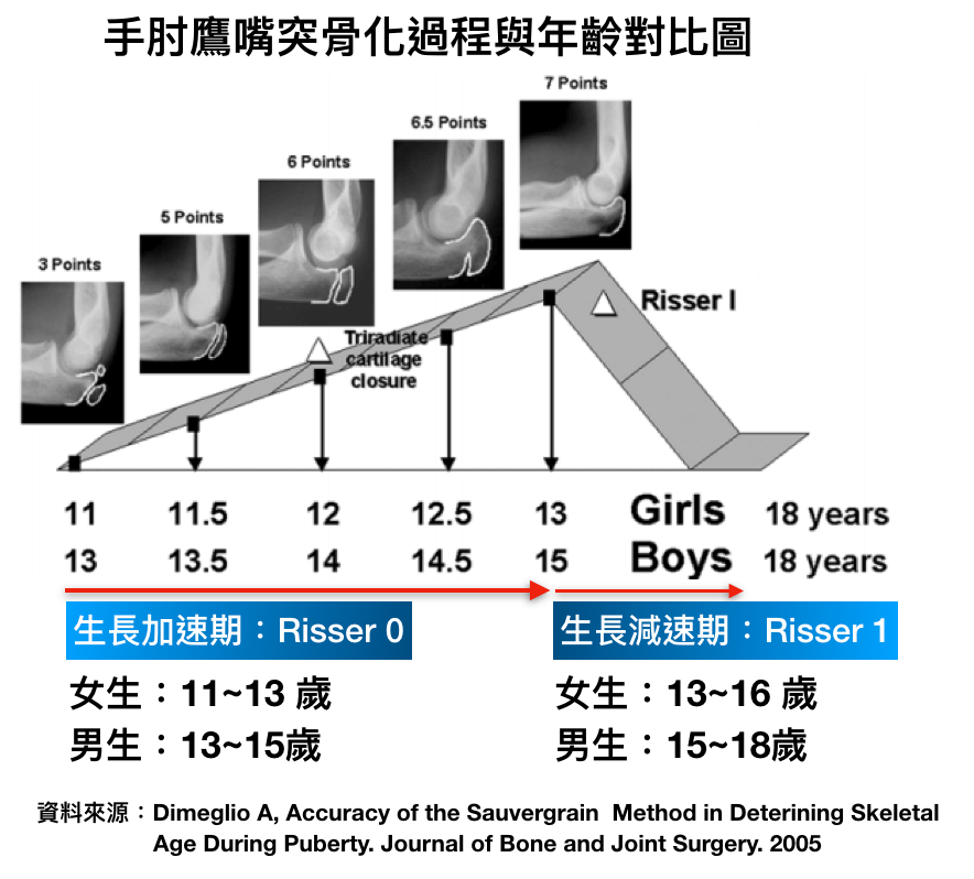 手肘骨齡判斷, 生長板閉合, 脊椎側彎, 骨齡判斷, 脊椎側彎評估