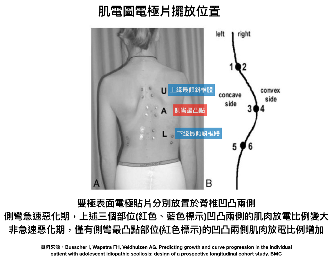 脊椎側彎, 肌電圖，脊椎側彎肌肉不對稱, 脊椎側彎惡化評估