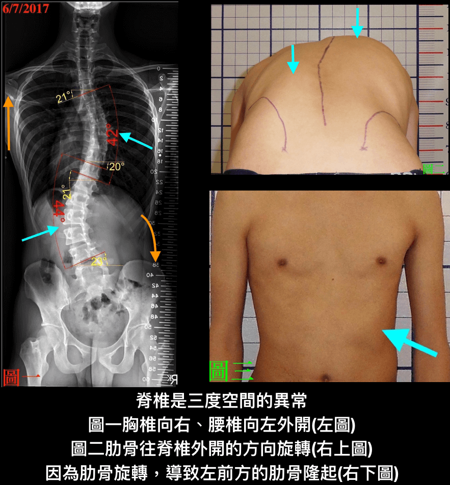 脊椎側彎是脊椎3度空間的變形