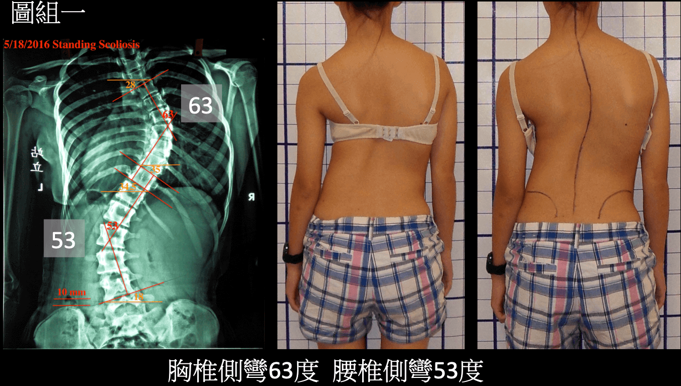 重度脊椎側彎，側彎度數63度及53度
