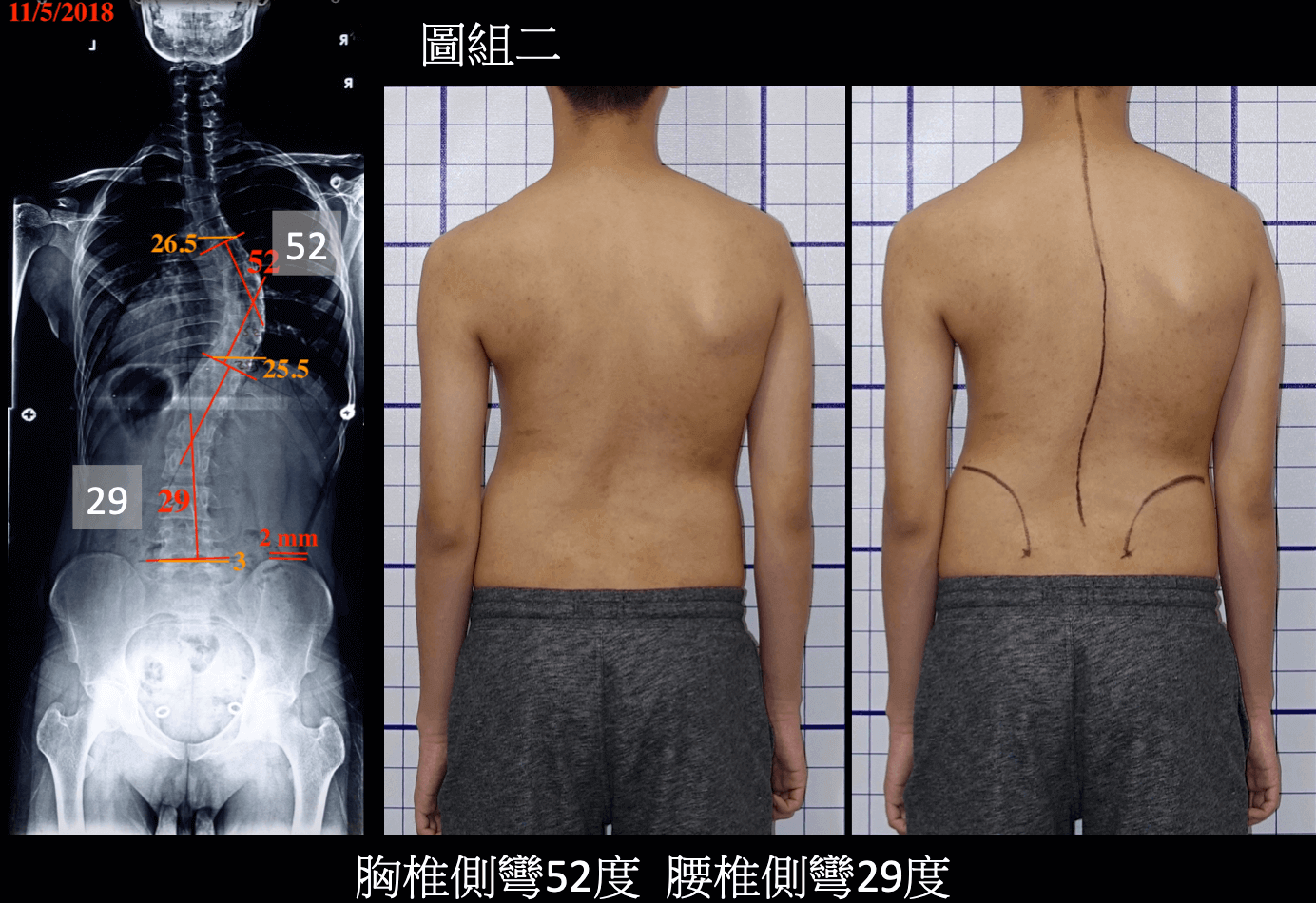 重度胸椎側彎52度、腰椎側彎29度