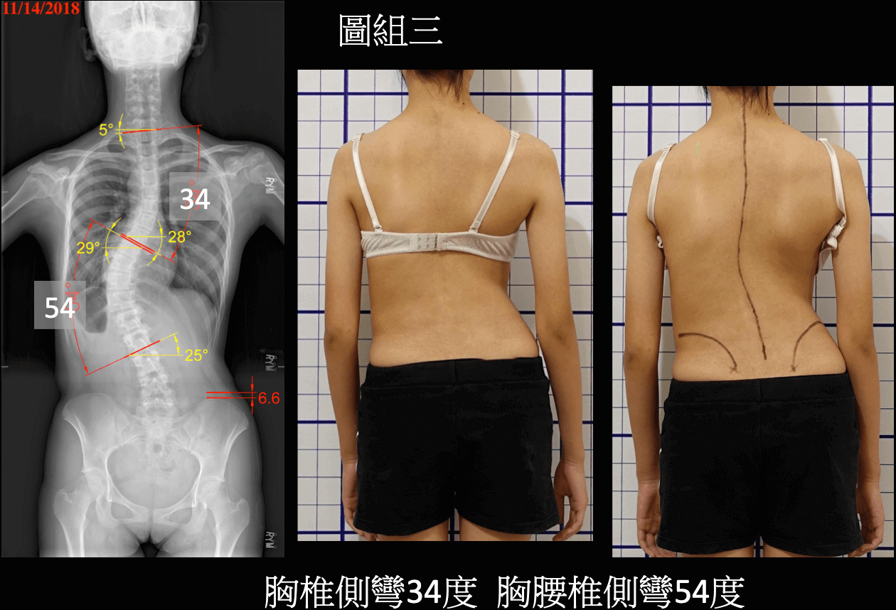 重度胸腰側彎