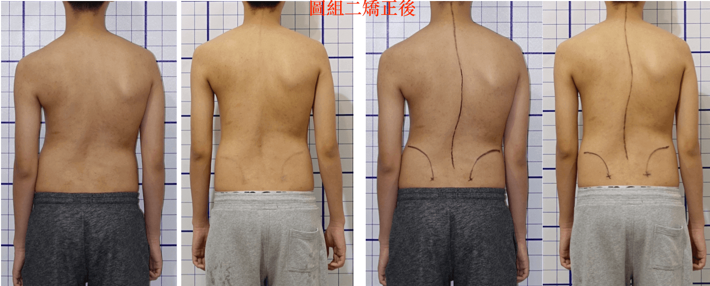 10天短期脊椎側彎密集訓練