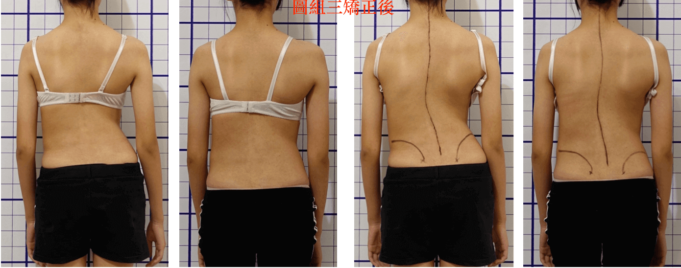 重度脊椎側彎治療後度數改善案例