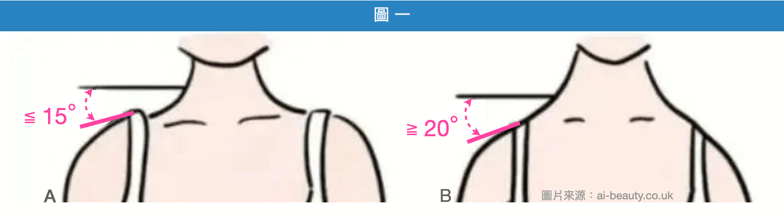 正常肩線與垂肩