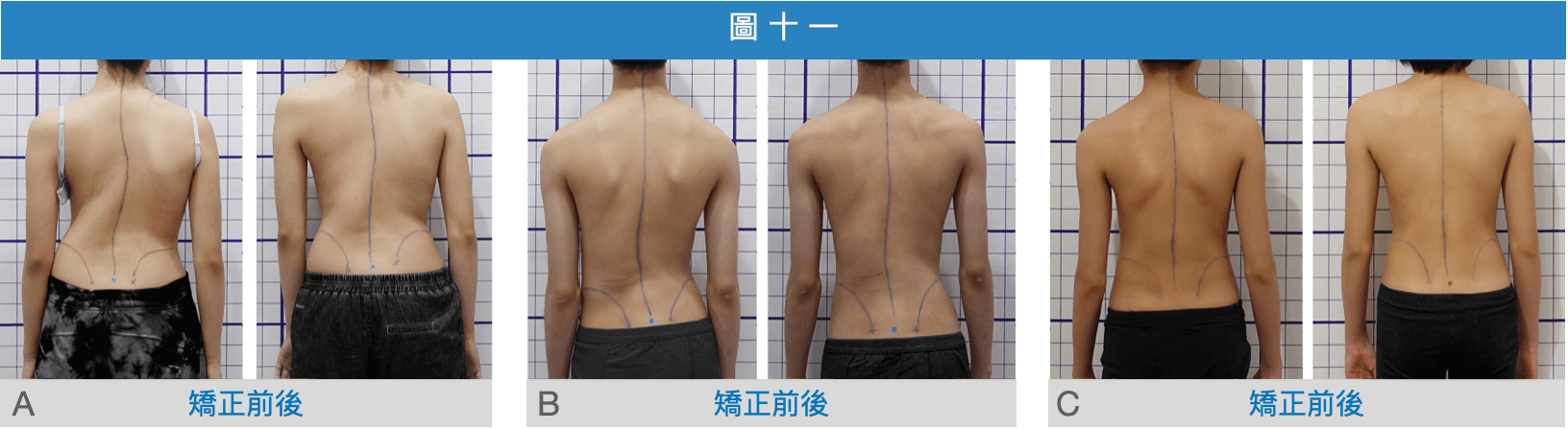 脊椎側彎旋轉肩與垂斜肩矯正前後照片