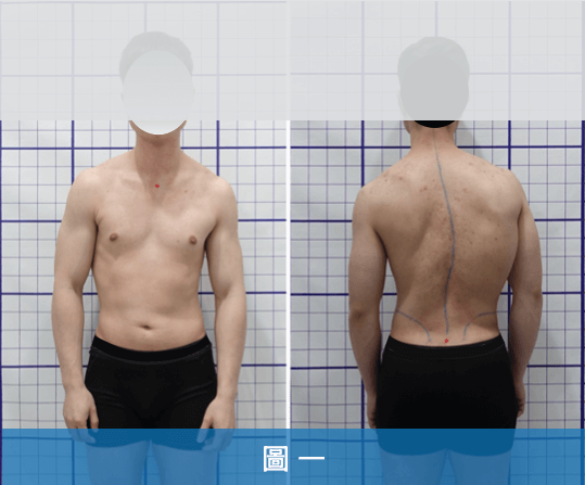 29歲胸椎側彎56度、腰椎側彎37度。曾積極進行2年半重訓，呈現高低肩、旋轉肩及垂肩加重側彎姿勢