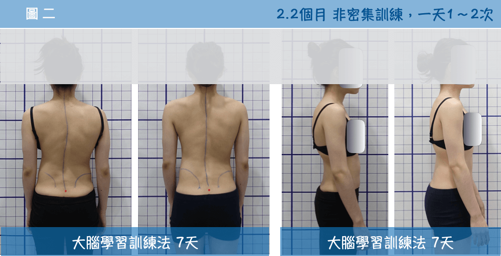 在2.2個月內共進行7天大腦學習訓練法，背部及側面軀幹攤開、變長、脊椎往中線靠近、僵硬酸痛獲得改善