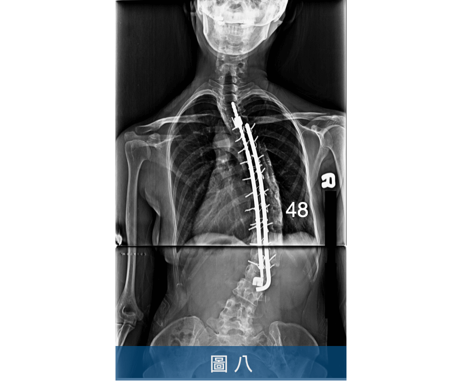 側彎術後30年，側彎度數反彈至接近手術前度數
