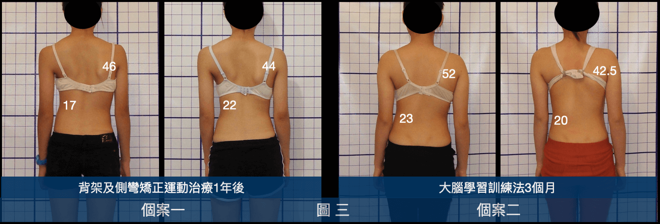 不同側彎治療方式對胸椎側彎矯正的影響