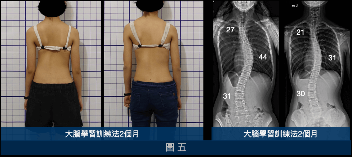 利用大腦學習訓練側彎矯正法2個月，同時改善姿勢外觀及側彎度數