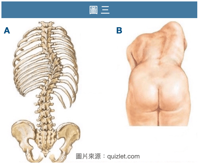 胸椎側彎、會伴隨胸椎及肋骨旋轉