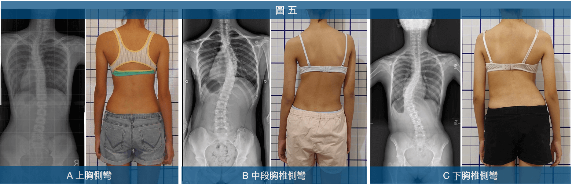 上、中、下段胸椎側彎會呈現不同的姿勢異常