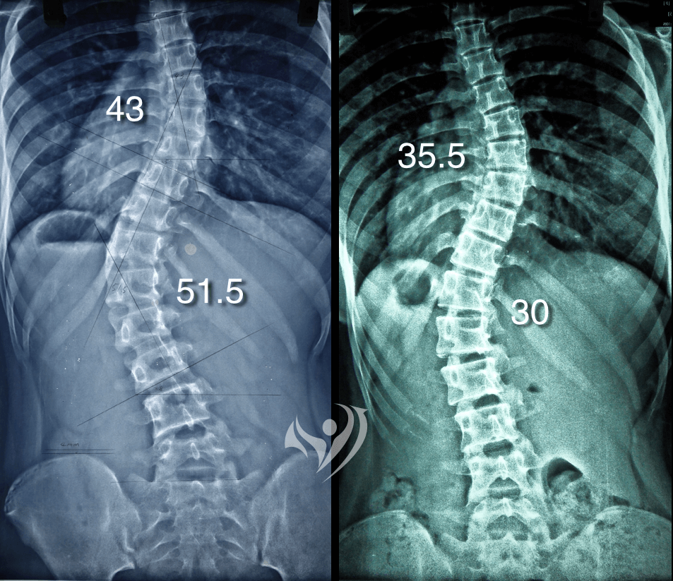 不利用脊椎側彎背架，嚴重腰椎側彎度數成功獲得改善51.5度降到30度
