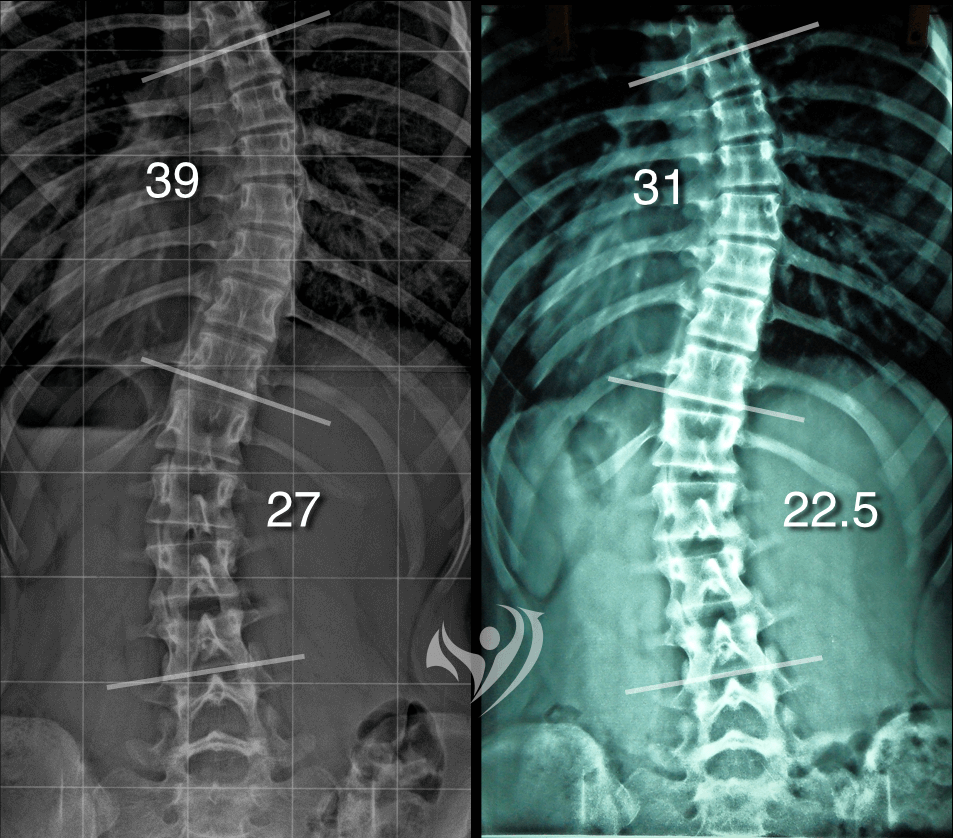 不利用背架，一個月同時改善中度胸椎及腰椎側彎度數