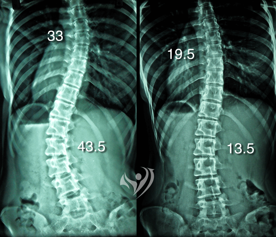 非手術成功改善側彎度數案例，中大角度胸椎、腰椎側彎度數同時獲得大幅度改善