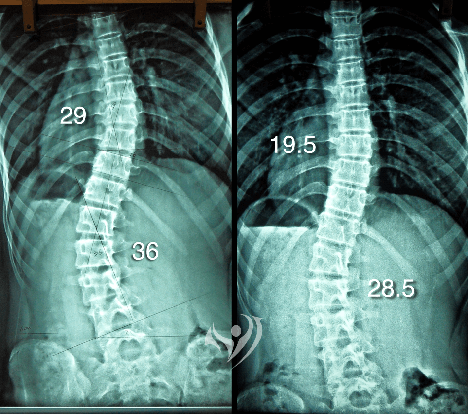 S形中度脊椎側彎，胸椎及腰椎側彎度數同時獲得改善