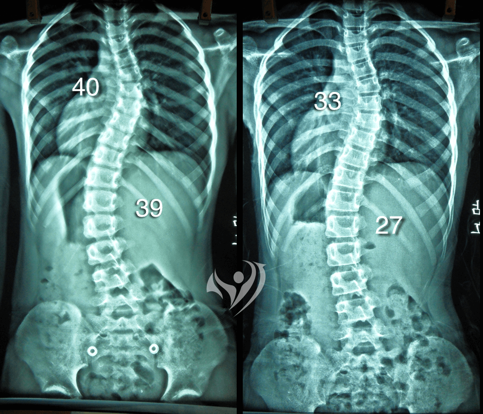 10歲S形中大角度脊椎側彎，胸椎及腰椎側彎度數同時獲得改善，側彎度數分別由40度降到33度、及39度降到27度