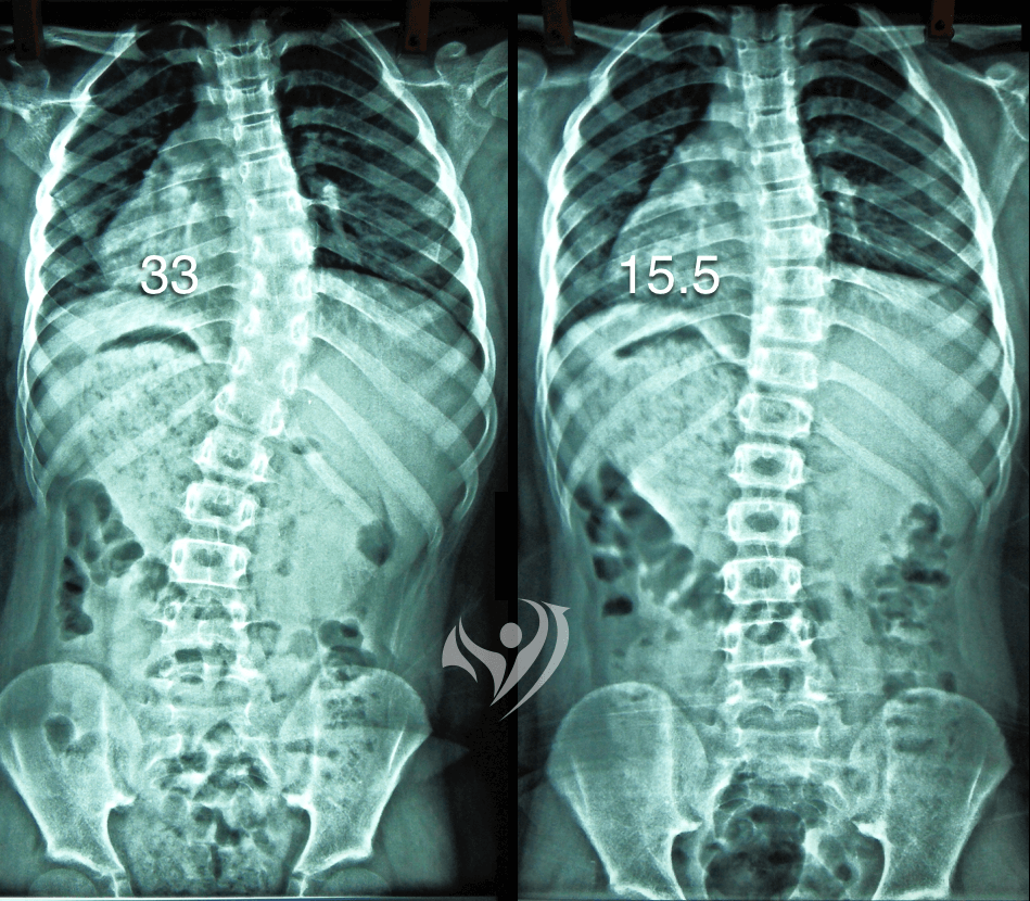 2個月內中度胸椎側彎由33度降為15.5度