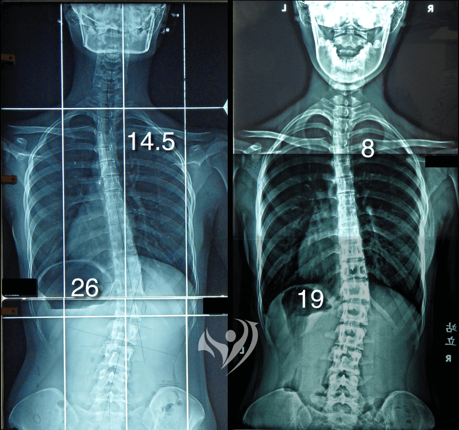 中度胸腰側彎伴隨輕度上胸側彎，矯正10次，胸腰側彎由26度降至19度