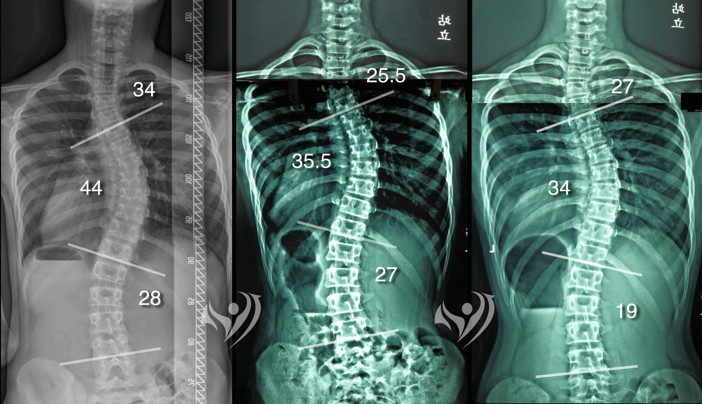 同時改善中重度3曲線脊椎側彎矯正案例