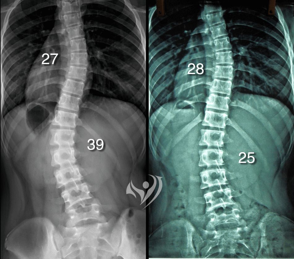 腰椎側彎39度，矯正10次，側彎度數降為25度