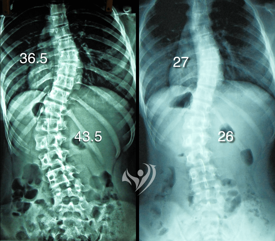 5天短期密集訓練，中重度S形脊椎側彎度數明顯改善35.5降為27度、43.5度降為26度