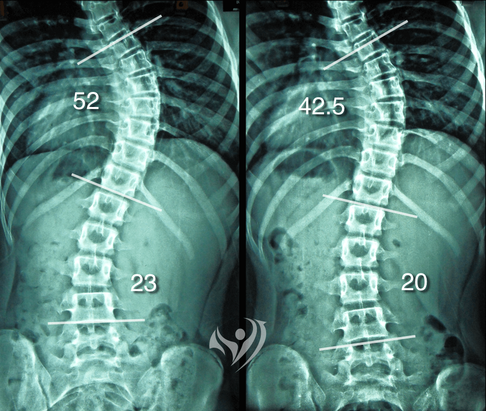 重度脊椎側彎達手術標準，不利用背架，改善脊椎側彎度數