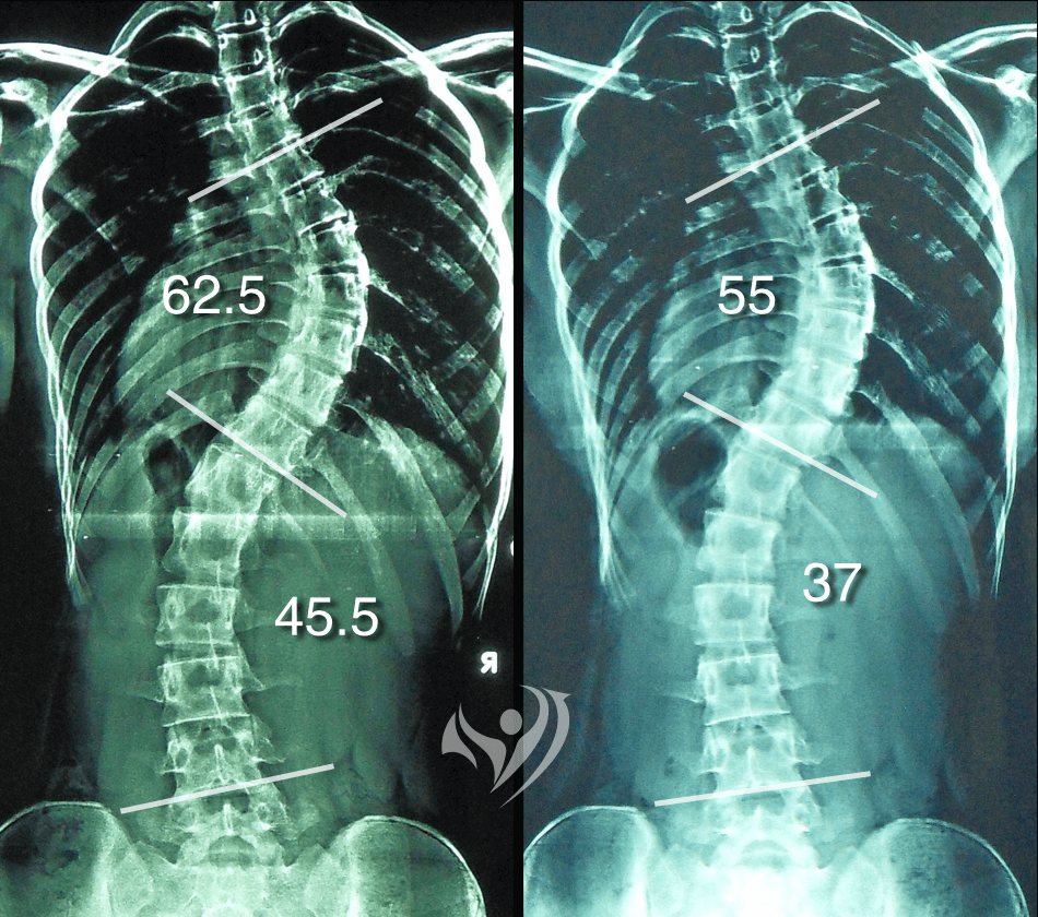 來自香港參加密集訓練課程，極重度S形脊椎側彎同時改善胸椎及腰椎側彎度數