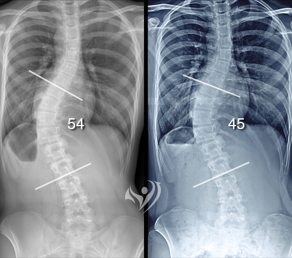 不利用側彎背架，改善重度胸腰脊椎側彎54度降到45度