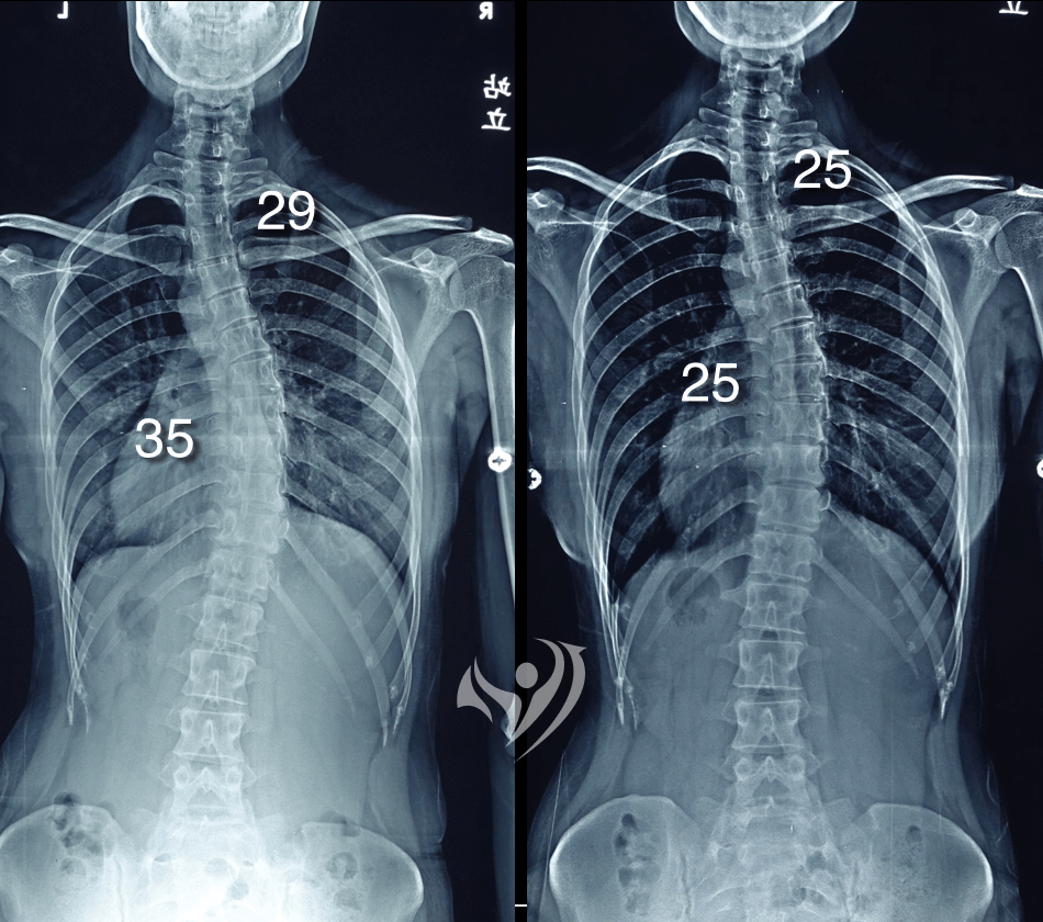 成年人中度胸椎S形脊椎側彎度數由35度降為25度