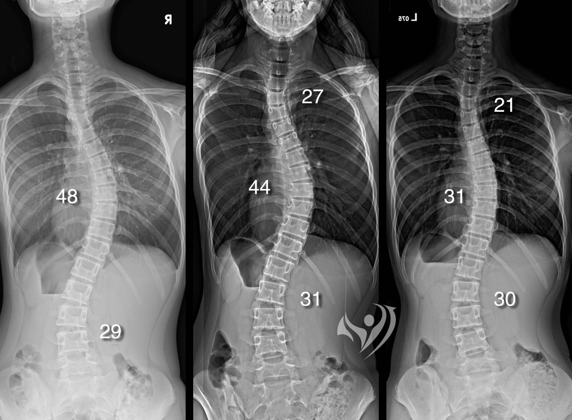 2個月同時改善3曲線脊椎側彎度數，胸椎側彎44度降到31度