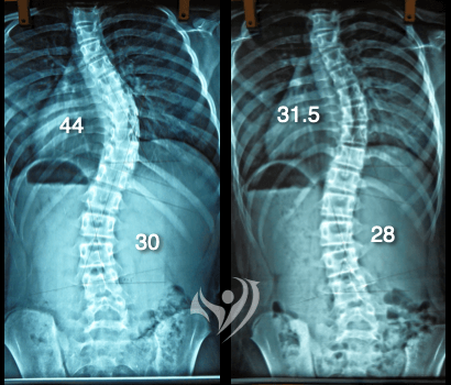 重度胸椎側彎度數改善案例44度降到31.5度