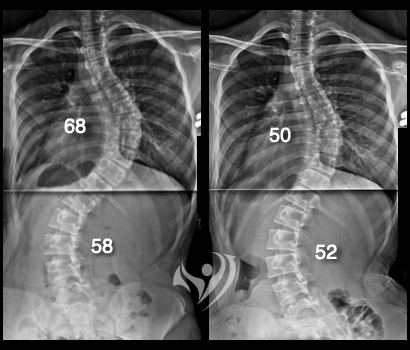 矯正一個月胸椎側大幅度進步18度(68度→50度)