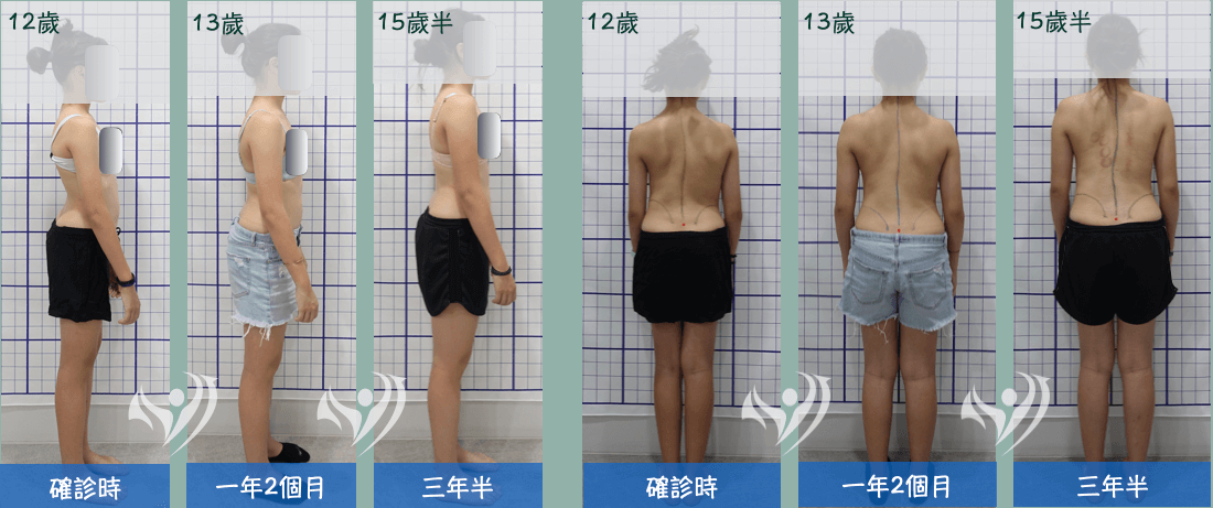 12歲重度側彎女孩利用大腦學習訓練法成功逆轉側彎,3年半後仍維持矯正成效