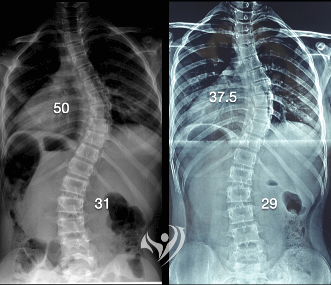 12歲成功改善重度脊椎側彎，胸椎側彎50度→37.5度