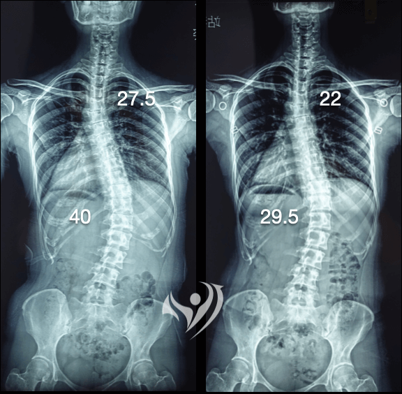 成人側彎度數改善