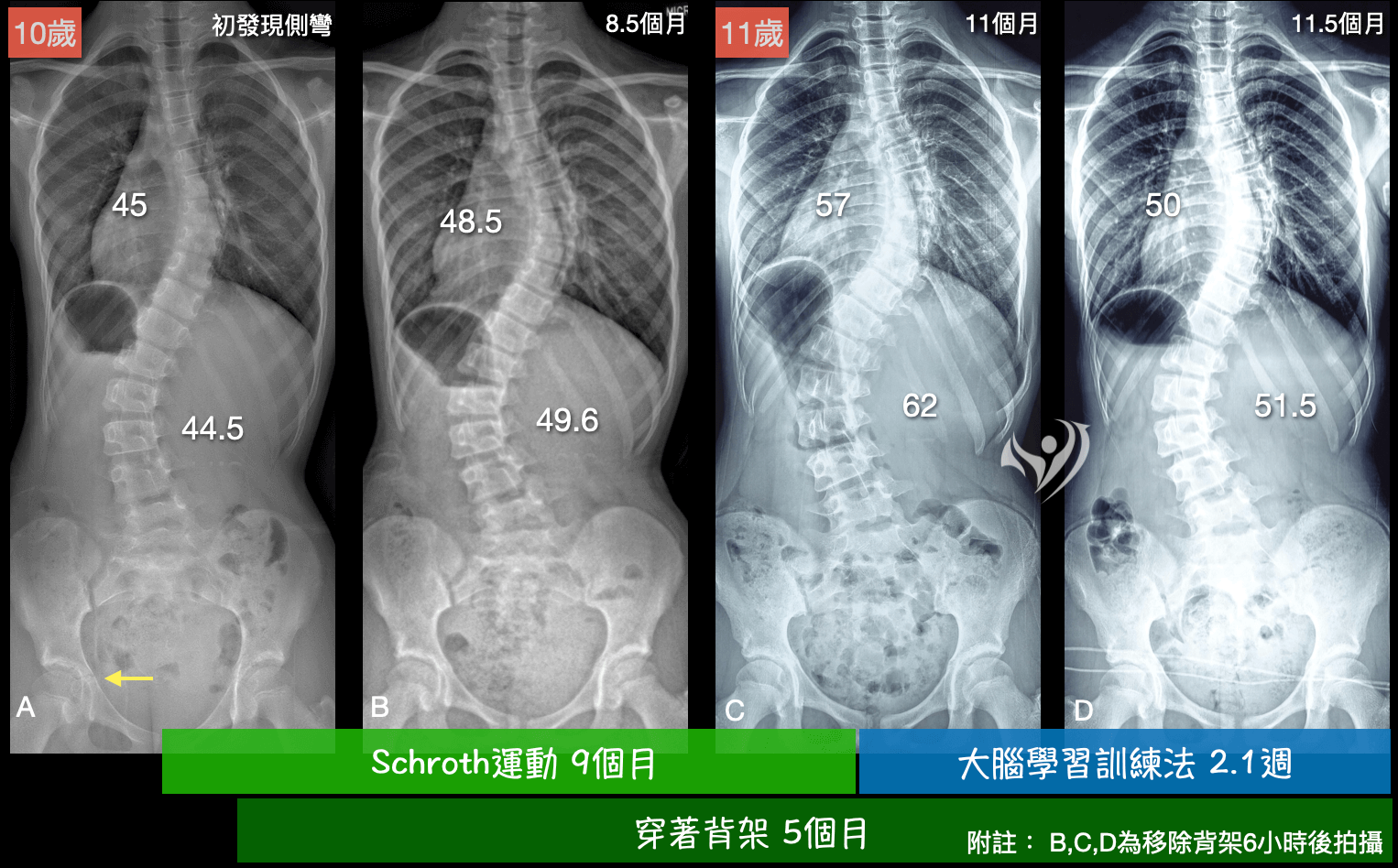 成功改善胸腰雙主彎