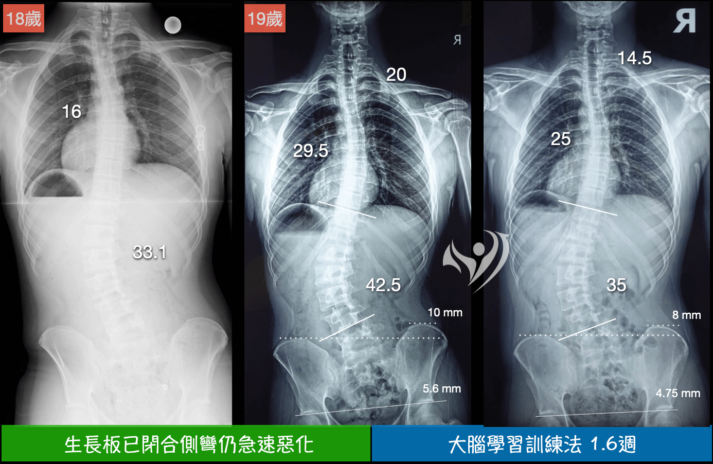 生長板閉合仍急速惡化-1.6週改善脊椎側彎、X型腿及假性長短腳