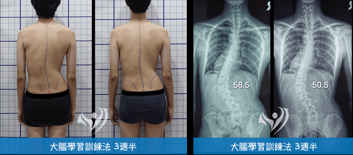 大腦學習訓練法短期改善重度脊椎側彎