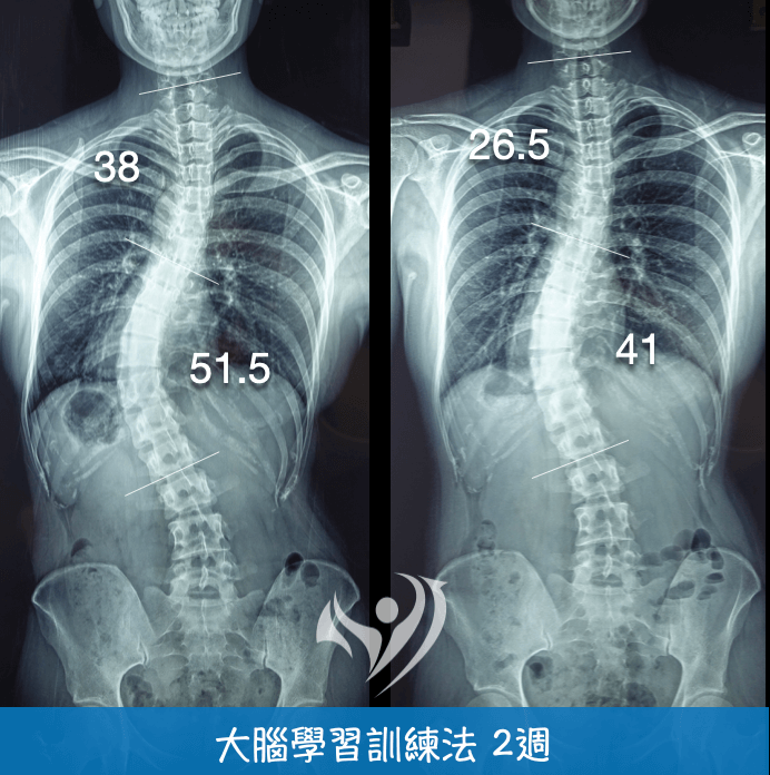 大腦學習訓練法密集訓練改善重度脊椎側彎51.5至41度