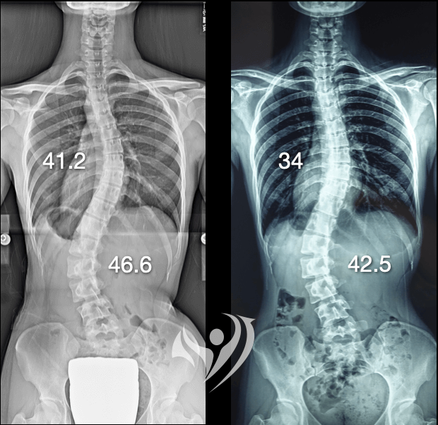 大腦學習訓練法挽救23歲側彎度數反彈至40多度案例