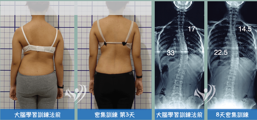 大腦學習訓練法密集訓練8天-成功矯正胸椎側彎33→22.5度