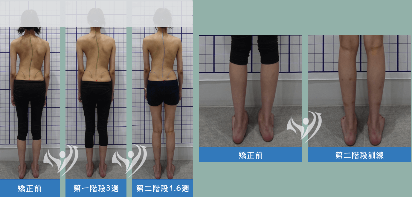 兩階段大腦學習訓練法密集訓練改善17歲胸椎側彎女孩側彎姿勢及跟骨外翻