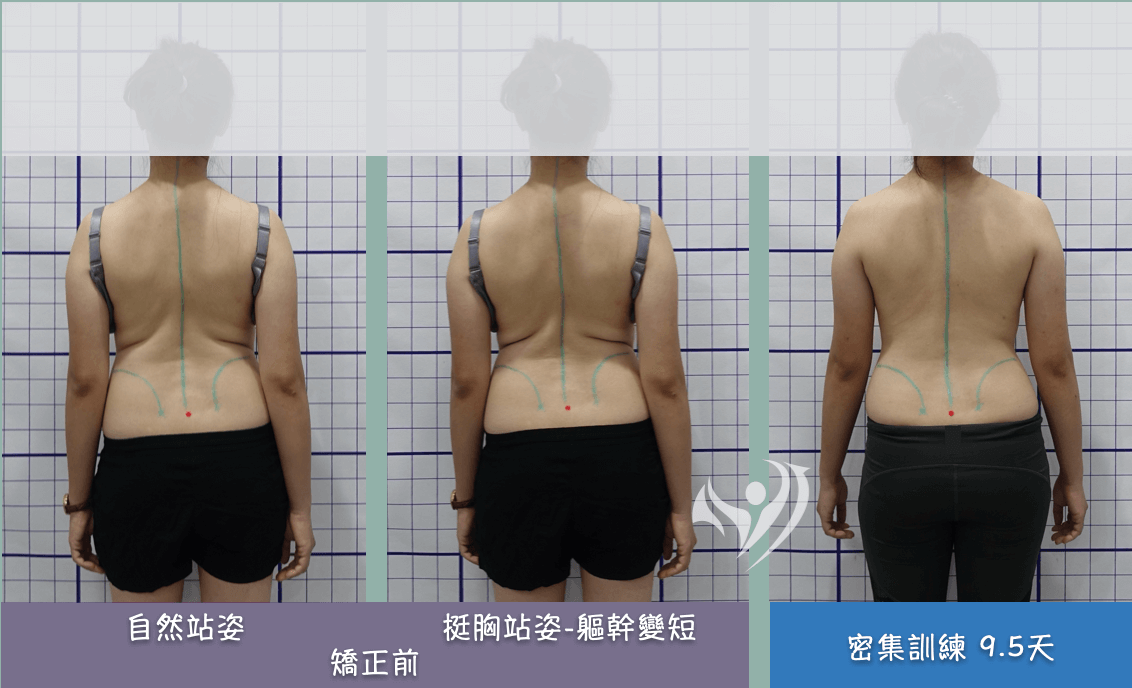 32歲輕度側彎因挺胸造成擠壓引發疼痛，大腦學習訓練法攤開背部改善緊繃酸痛