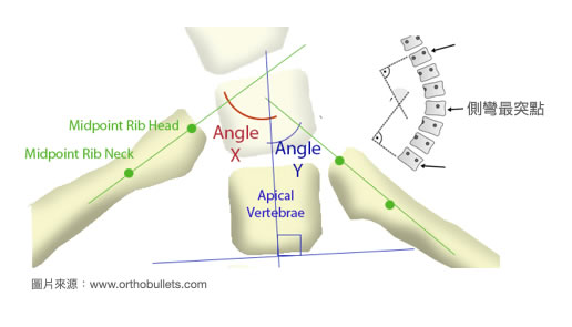 脊椎側彎曲線類型