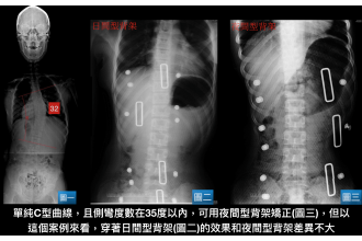 脊椎側彎背架的迷思！迷失？下